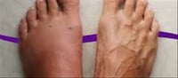 🦶 Feet Swelling in Summer? Causes, Signs & Easy Ways to Get Relief
